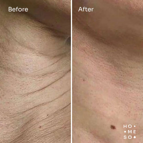 До і після — покращення в ділянці шиї