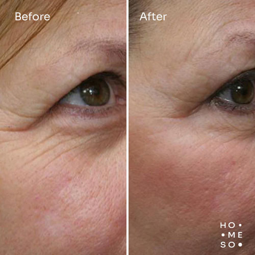 До і після — покращення в ділянці очей